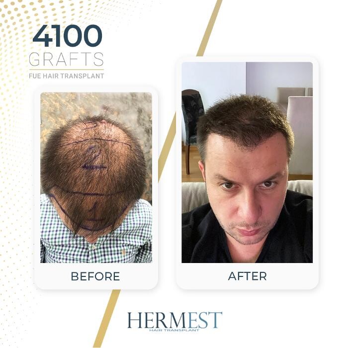 Images Hermest Hair Transplant Turkey
