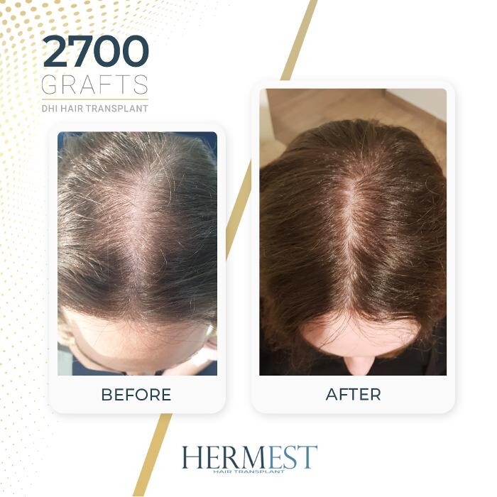 Images Hermest Hair Transplant Turkey