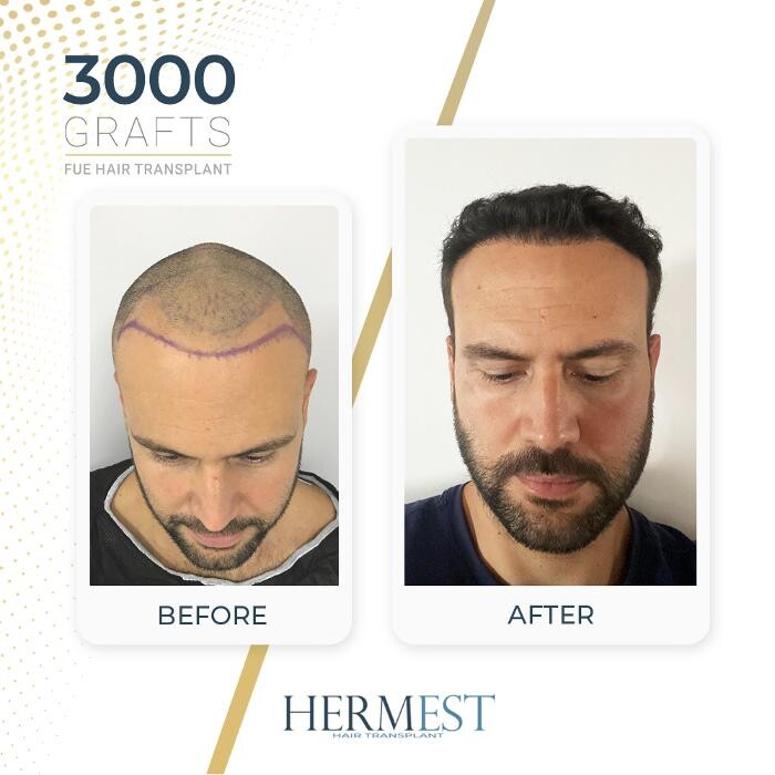 Images Hermest Hair Transplant Turkey