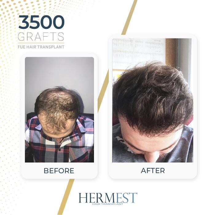 Images Hermest Hair Transplant Turkey