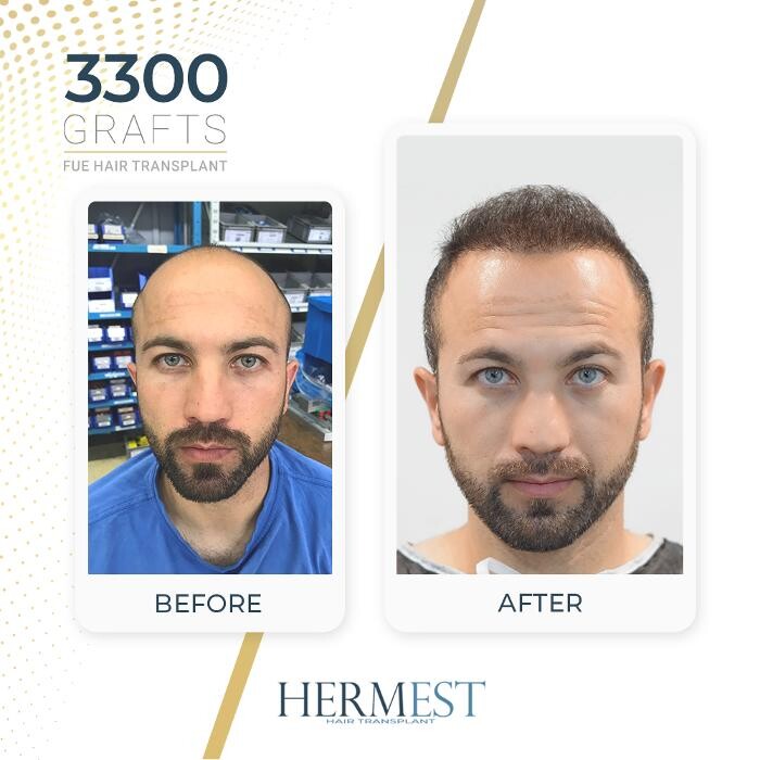 Images Hermest Hair Transplant Turkey
