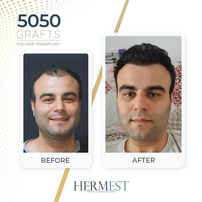 Images Hermest Hair Transplant Turkey