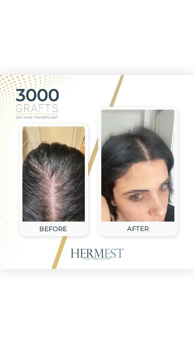 Images Hermest Hair Transplant Turkey