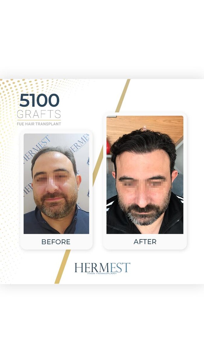 Images Hermest Hair Transplant Turkey