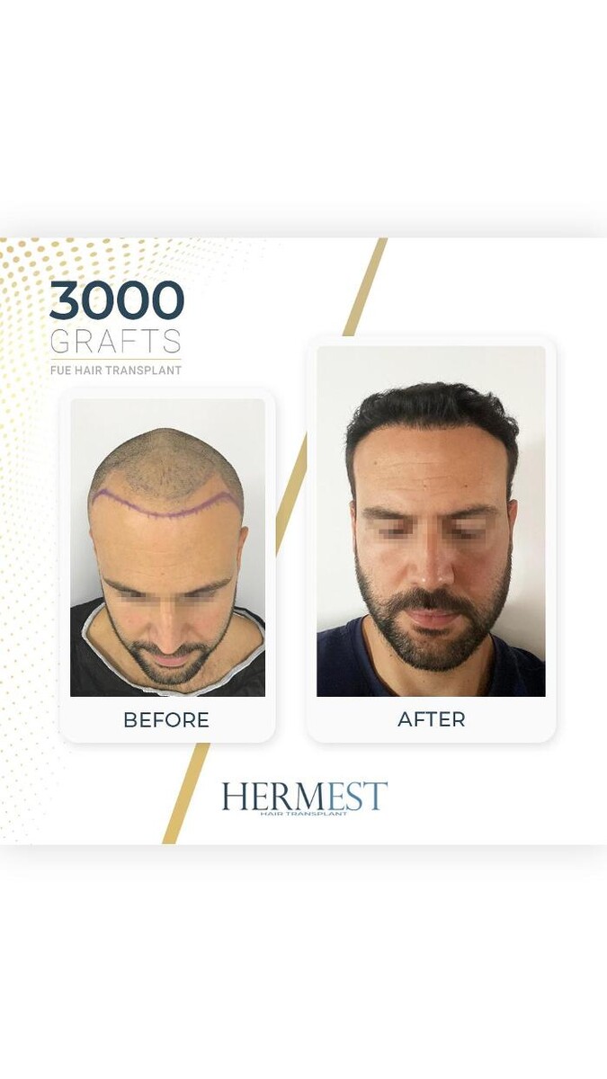 Images Hermest Hair Transplant Turkey
