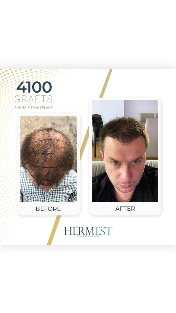 Images Hermest Hair Transplant Turkey