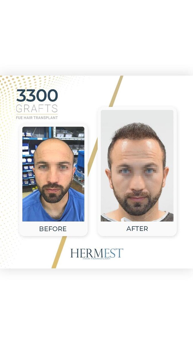 Images Hermest Hair Transplant Turkey