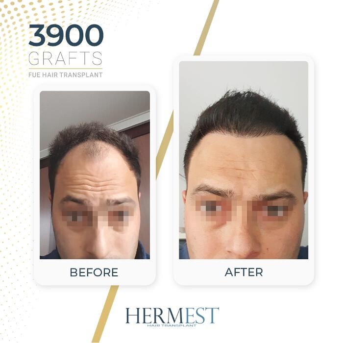 Images Hermest Hair Transplant Turkey