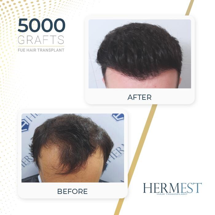 Images Hermest Hair Transplant Turkey