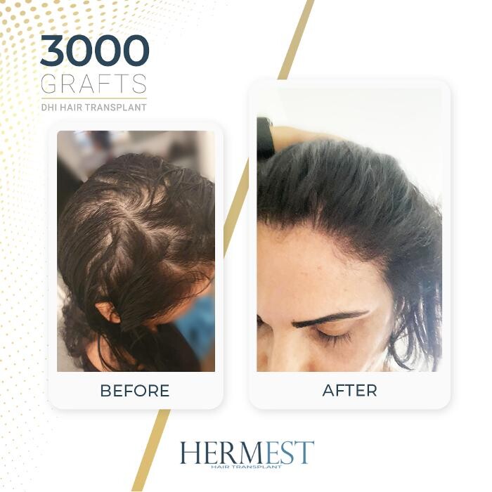 Images Hermest Hair Transplant Turkey