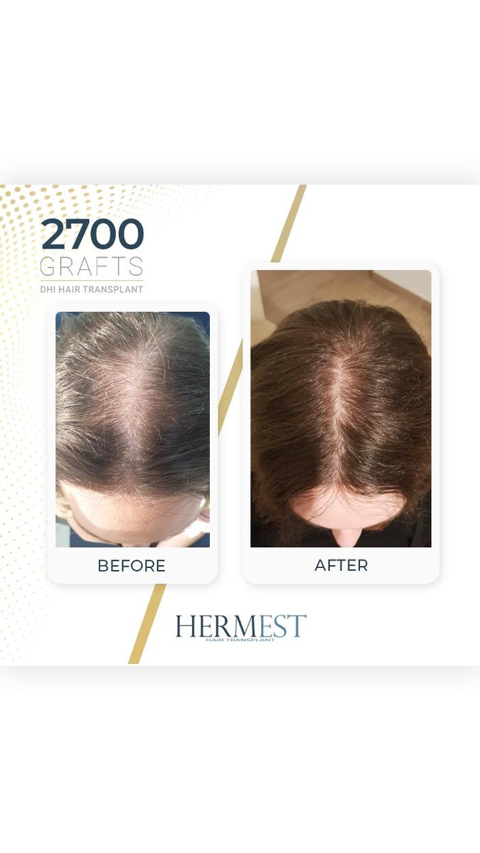 Images Hermest Hair Transplant Turkey