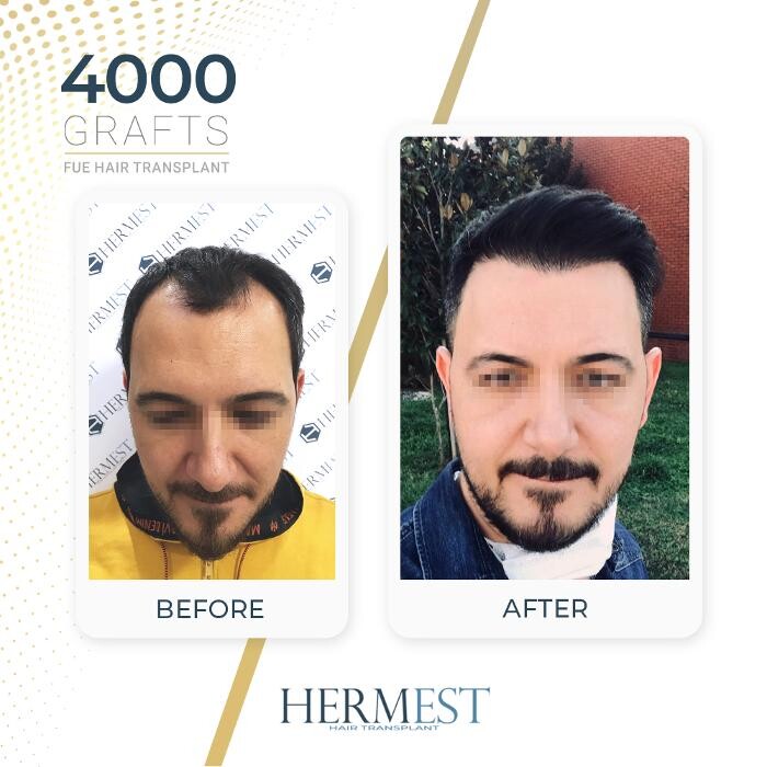Images Hermest Hair Transplant Turkey