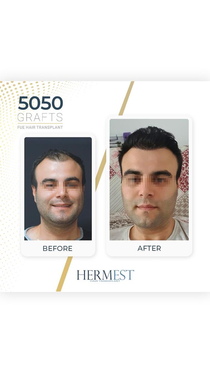 Images Hermest Hair Transplant Turkey