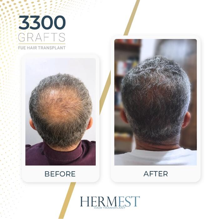 Images Hermest Hair Transplant Turkey
