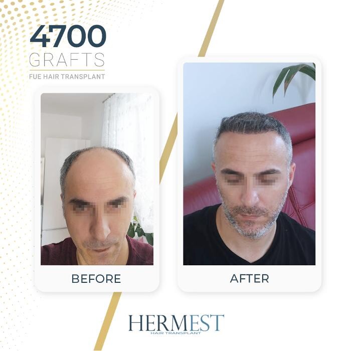 Images Hermest Hair Transplant Turkey