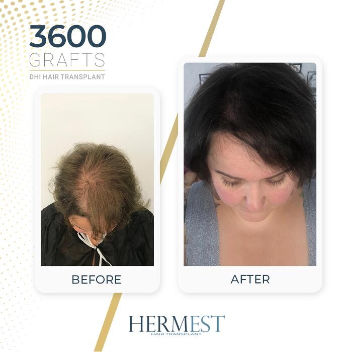 Images Hermest Hair Transplant Turkey