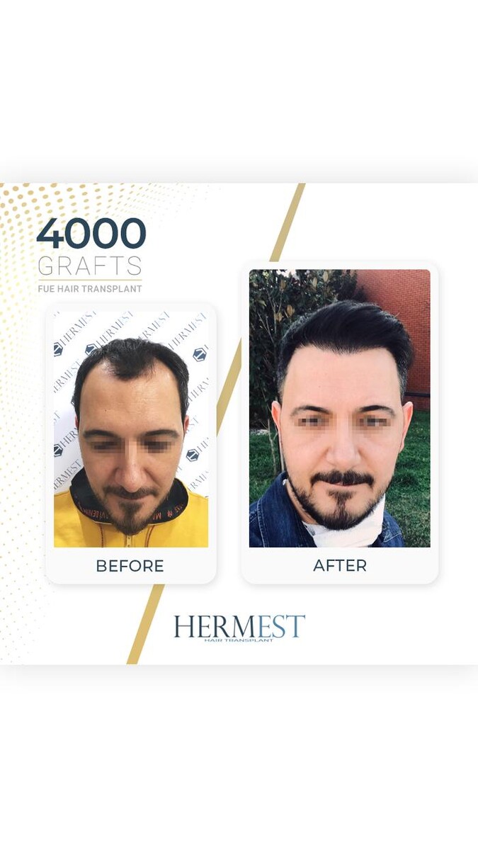 Images Hermest Hair Transplant Turkey