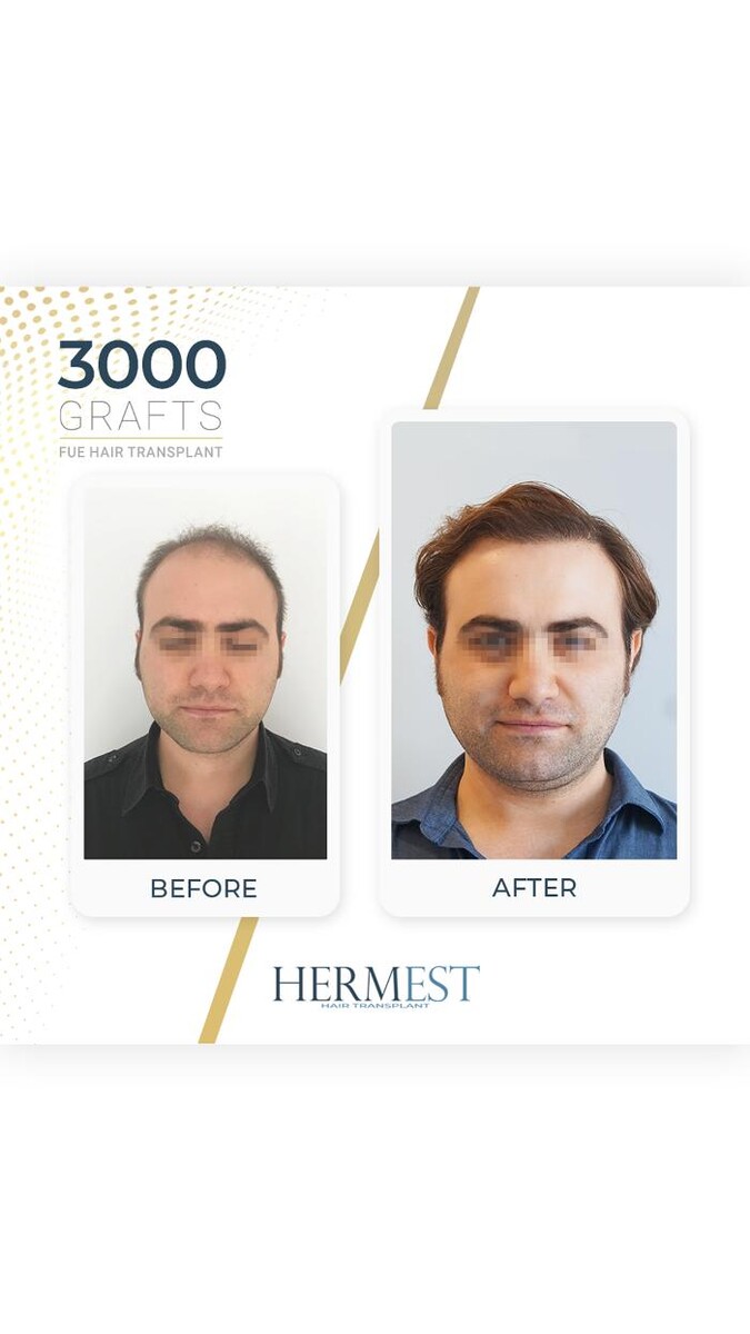 Images Hermest Hair Transplant Turkey
