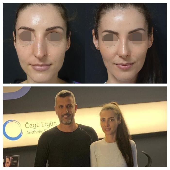 Images Dr Ozge Ergun Aesthetic Surgery-Breast Lift-Face Lift-Rhinoplasty-Vaser Liposuction-BBL