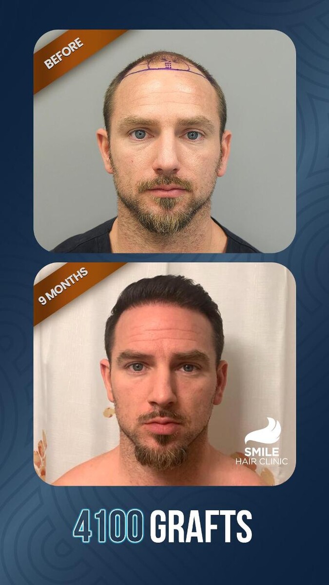 Images Smile Hair Transplant Clinic Turkey Istanbul