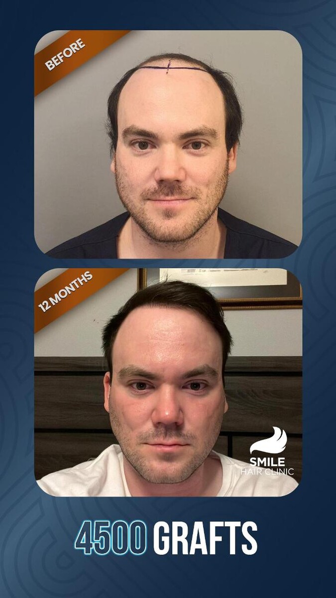 Images Smile Hair Transplant Clinic Turkey Istanbul