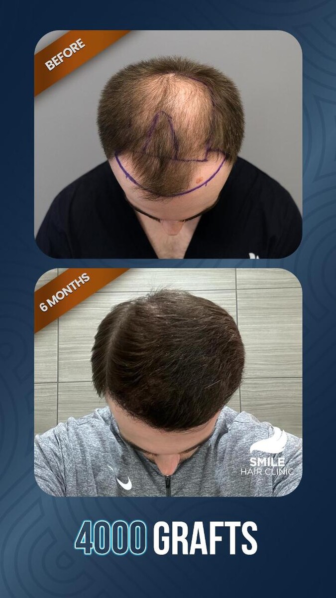 Images Smile Hair Transplant Clinic Turkey Istanbul