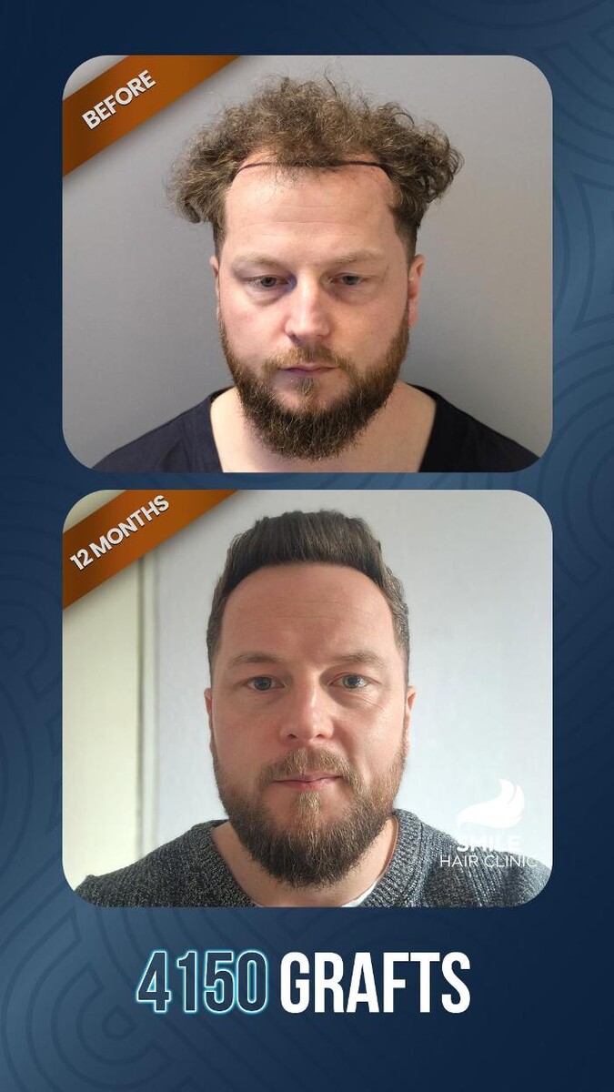 Images Smile Hair Transplant Clinic Turkey Istanbul