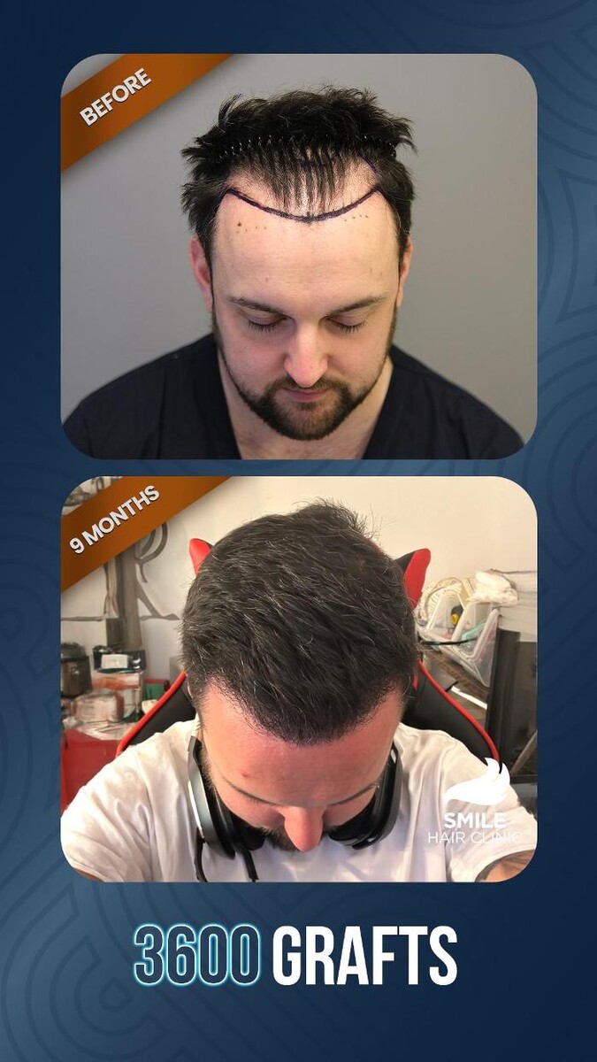 Images Smile Hair Transplant Clinic Turkey Istanbul