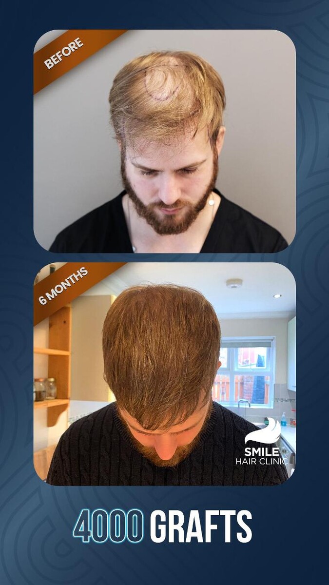 Images Smile Hair Transplant Clinic Turkey Istanbul