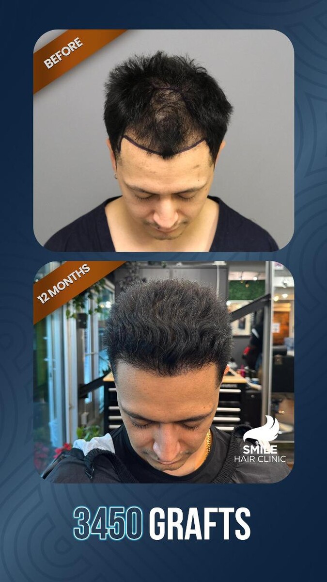 Images Smile Hair Transplant Clinic Turkey Istanbul