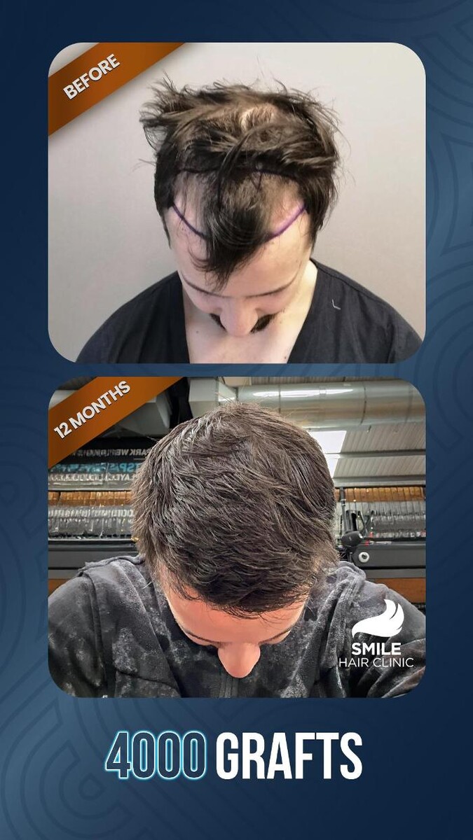 Images Smile Hair Transplant Clinic Turkey Istanbul