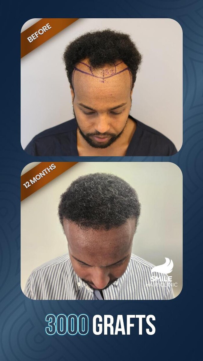 Images Smile Hair Transplant Clinic Turkey Istanbul