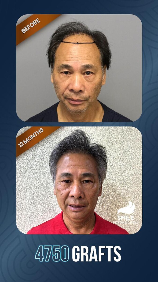 Images Smile Hair Transplant Clinic Turkey Istanbul