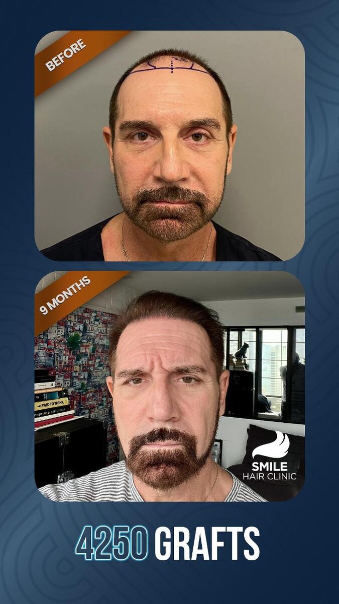 Images Smile Hair Transplant Clinic Turkey Istanbul