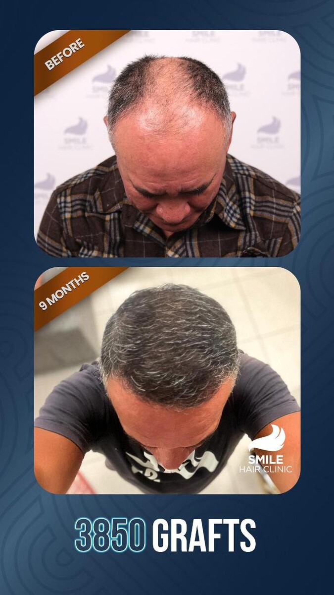 Images Smile Hair Transplant Clinic Turkey Istanbul