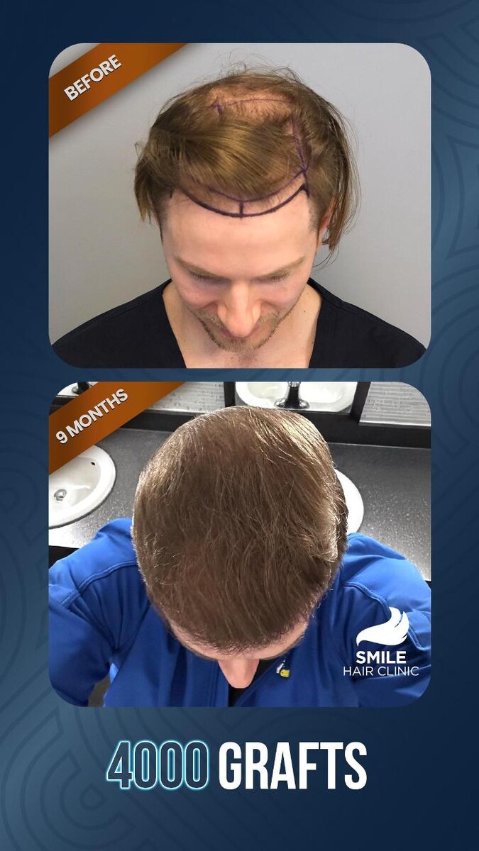 Images Smile Hair Transplant Clinic Turkey Istanbul