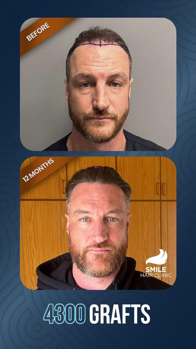 Images Smile Hair Transplant Clinic Turkey Istanbul