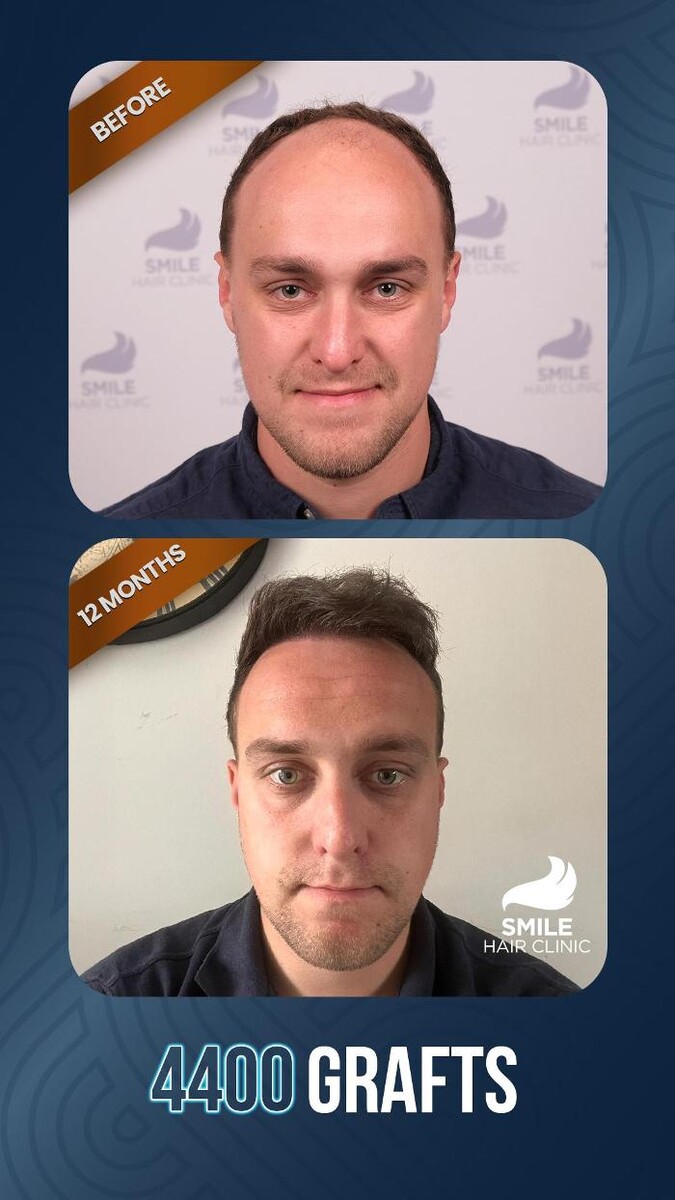 Images Smile Hair Transplant Clinic Turkey Istanbul