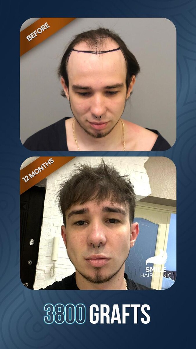 Images Smile Hair Transplant Clinic Turkey Istanbul