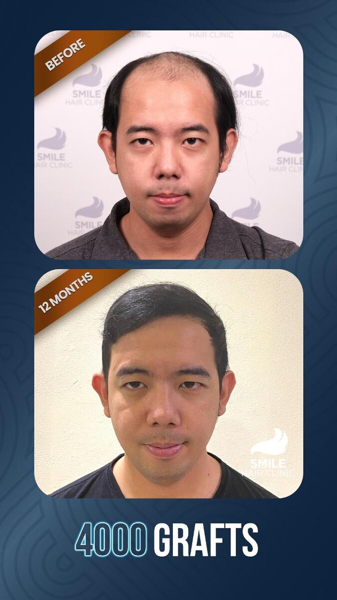 Images Smile Hair Transplant Clinic Turkey Istanbul