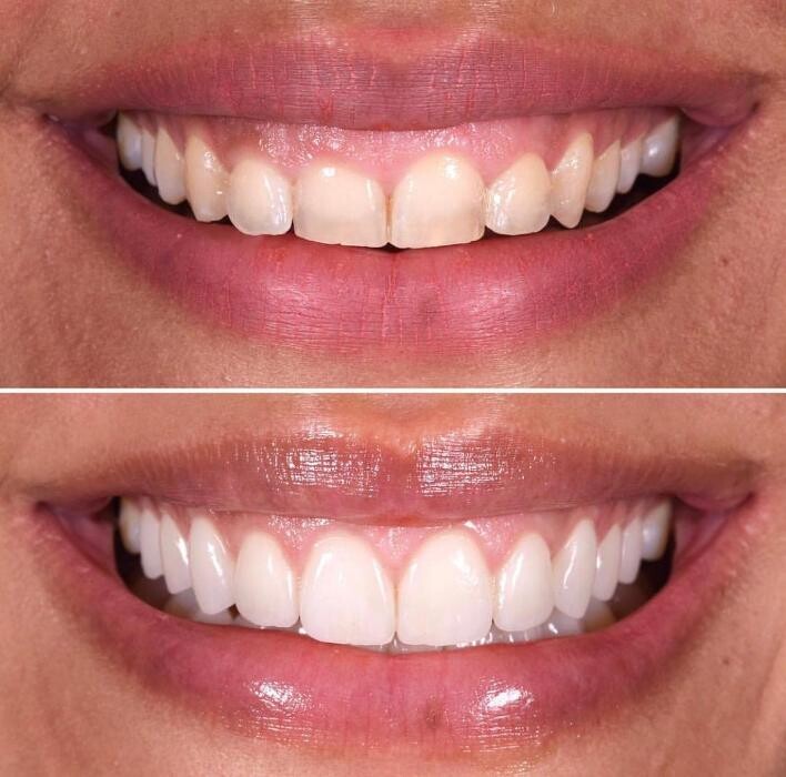 Images DentMax İstanbul Ağız ve Diş Sağlığı Polikliniği / invisalign - implant - lamine