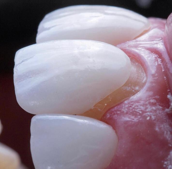 Images DentMax İstanbul Ağız ve Diş Sağlığı Polikliniği / invisalign - implant - lamine