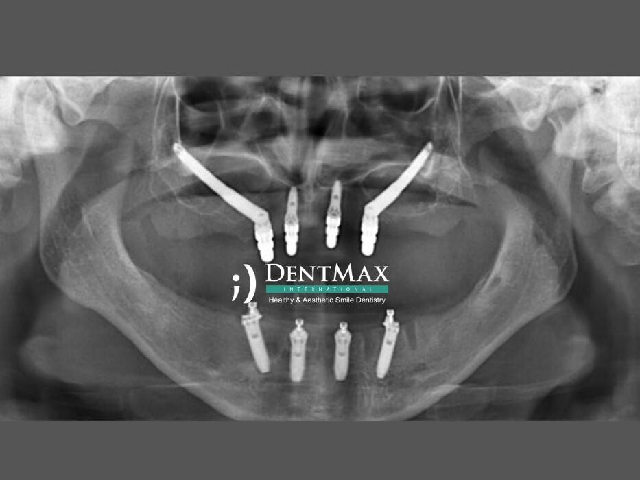 Images DentMax İstanbul Ağız ve Diş Sağlığı Polikliniği / invisalign - implant - lamine