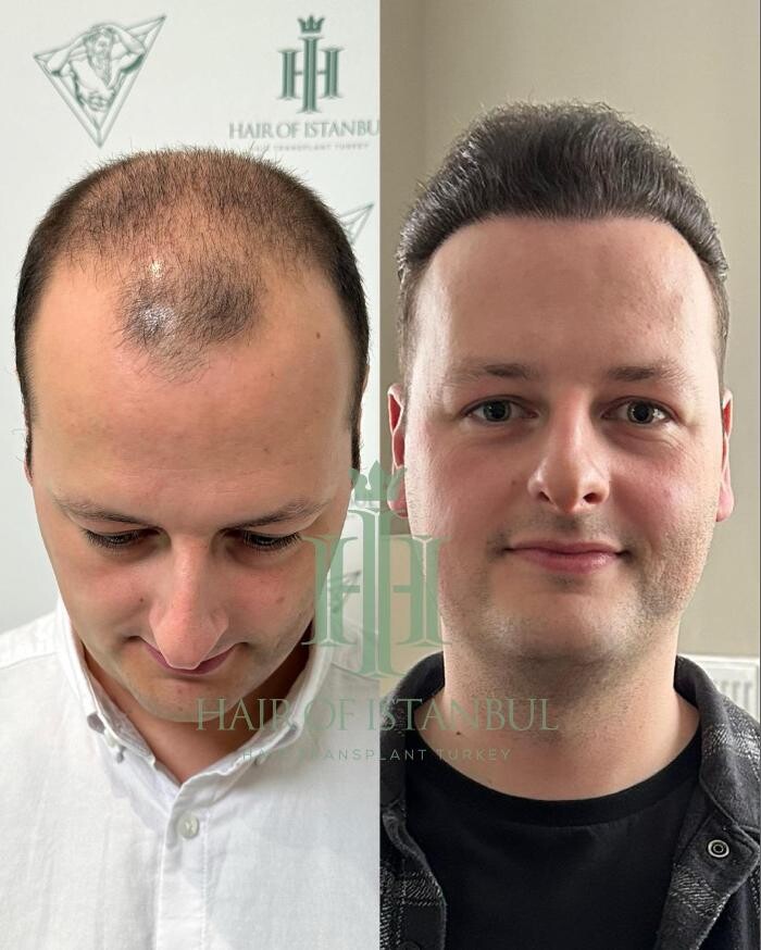Images Hair of Istanbul | Hair Transplant Clinic
