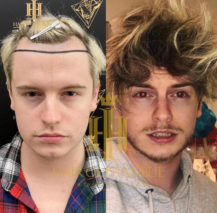 Images Hair of Istanbul | Hair Transplant Clinic