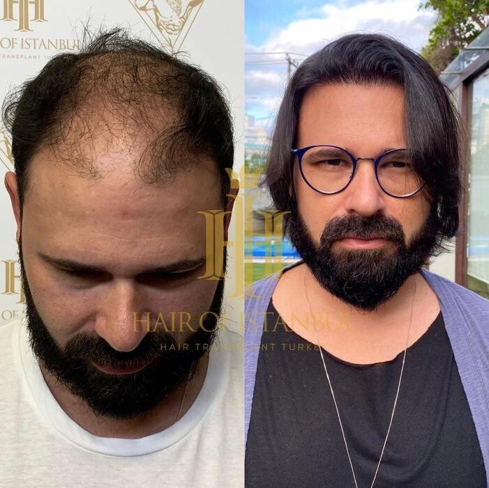Images Hair of Istanbul | Hair Transplant Clinic