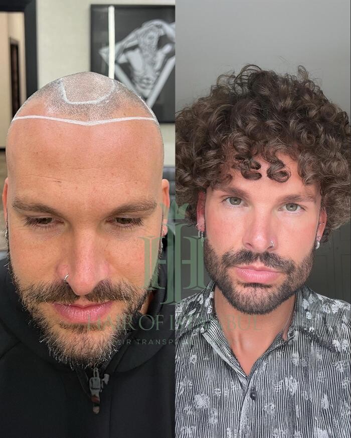 Images Hair of Istanbul | Hair Transplant Clinic