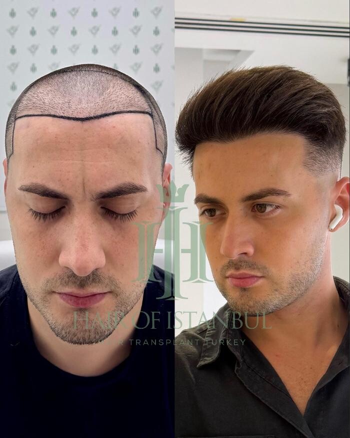 Images Hair of Istanbul | Hair Transplant Clinic