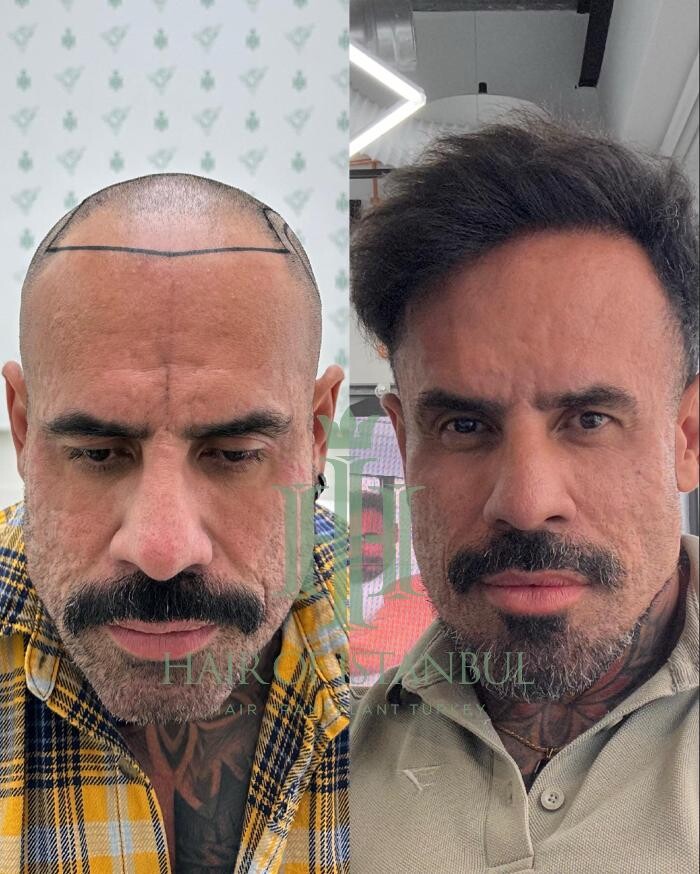 Images Hair of Istanbul | Hair Transplant Clinic