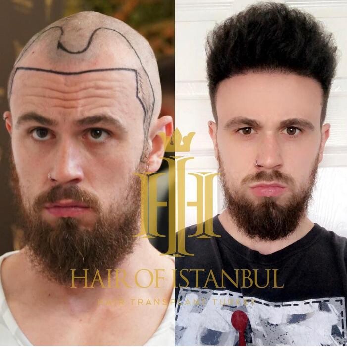 Images Hair of Istanbul | Hair Transplant Clinic